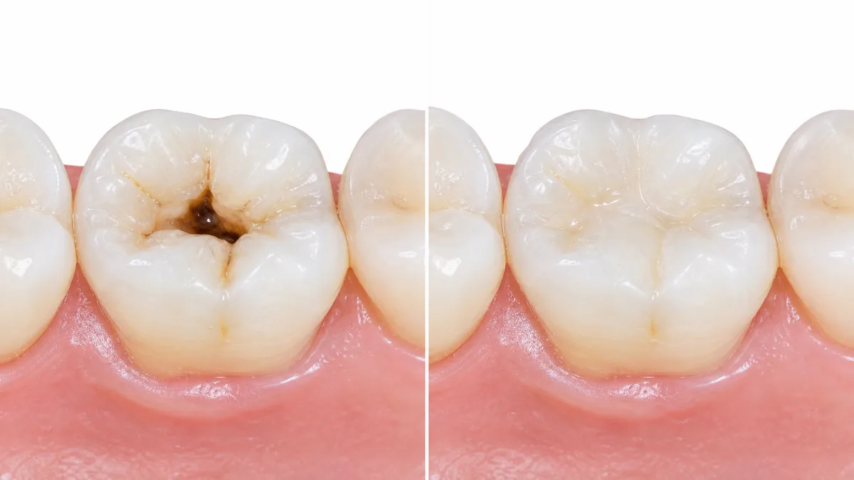 Before and after comparison showing a tooth cavity filled with tooth-colored composite resin at Sunrays Smiles Dental Care in Winter Springs, Florida